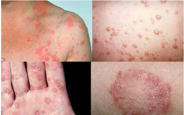 Các bệnh xã hội thường gặp nguy hiểm và khó chữa nhất