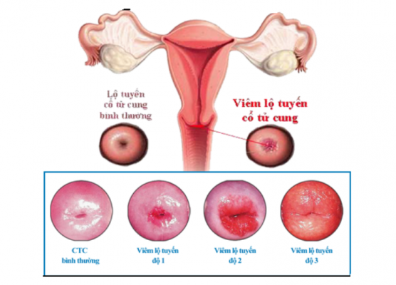 Viêm lộ tuyến cổ tử cung: Nguyên nhân, dấu hiệu, hình ảnh và cách điều trị