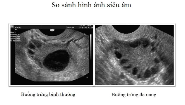 hinh-anh-sieu-am-buong-trung